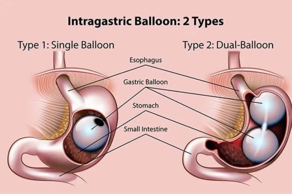 Intra Gastric Balloon | Best Laser Bariatric Surgery
