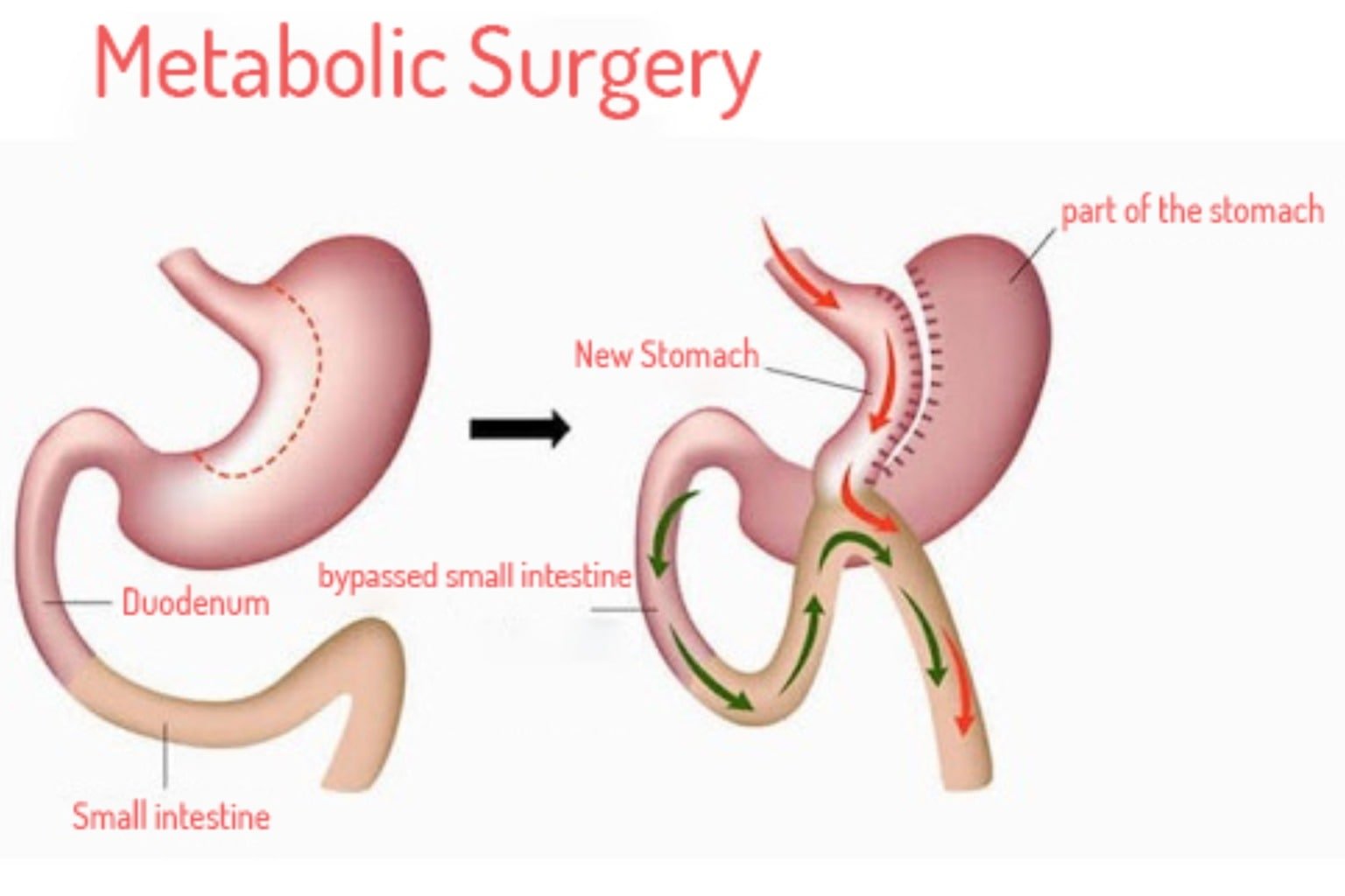 Metabolic Surgery in indore For Diabetes-Indore Laparoscopy Center