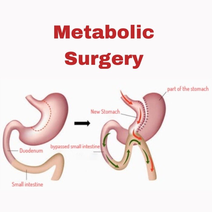 metabolic surgery in indore-Indore Laparoscopy Center