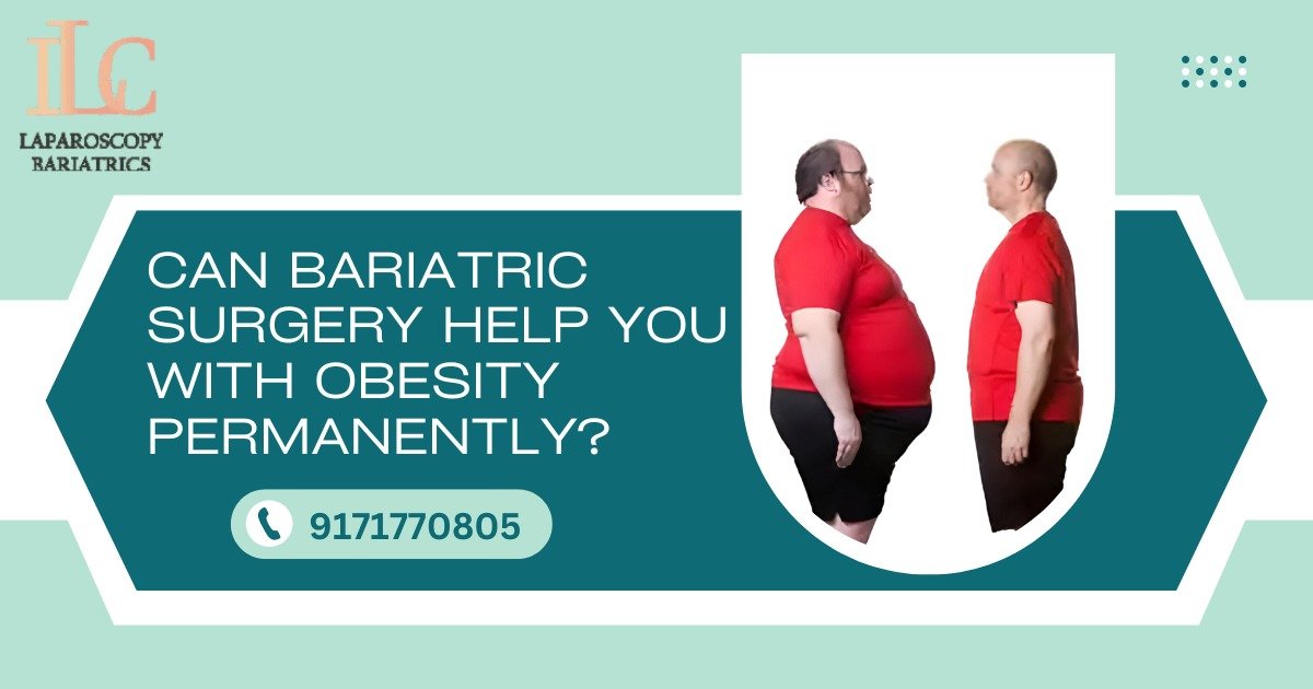 Can Bariatric Surgery Help You with Obesity Permanently?