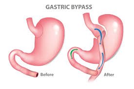 Bariatric Surgery