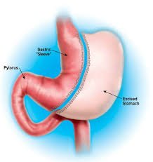 Bariatric Surgery