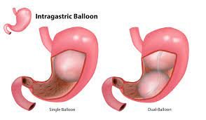 Bariatric Surgery