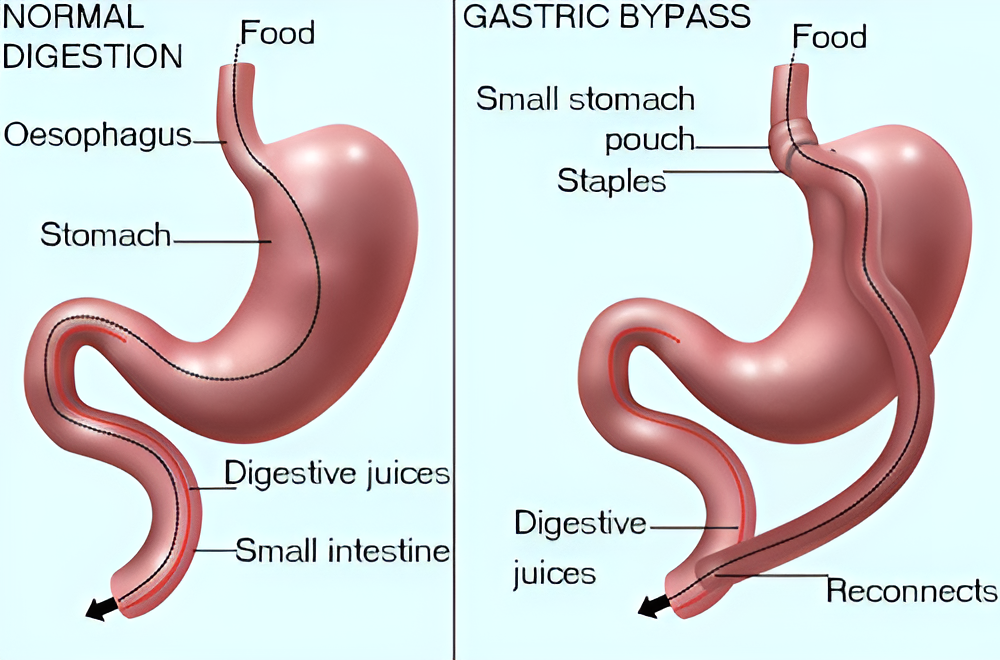 gastric bypass