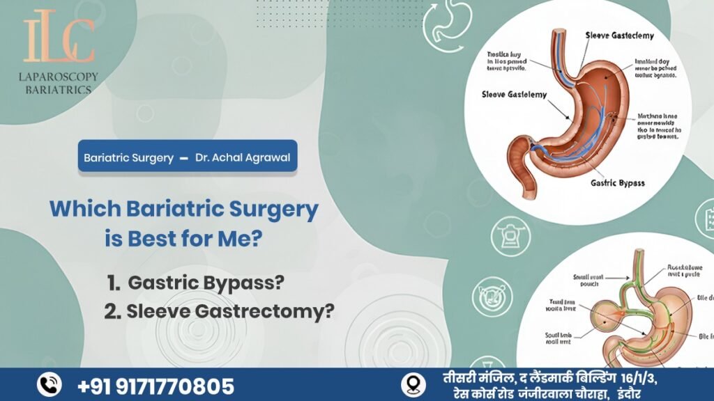 Which Bariatric Surgery is Best for Me – Sleeve Gastrectomy or Gastric Bypass