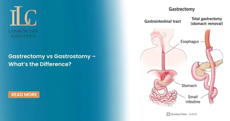Gastrectomy vs Gastrostomy – What’s the Difference?