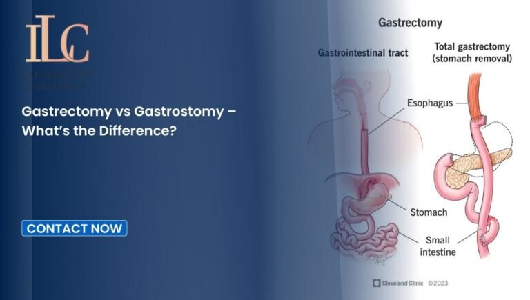 Gastrectomy vs Gastrostomy – What’s the Difference?