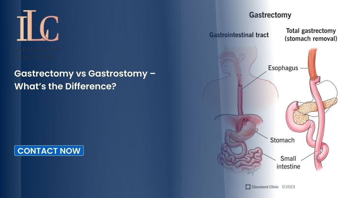 Gastrectomy vs Gastrostomy – What’s the Difference?