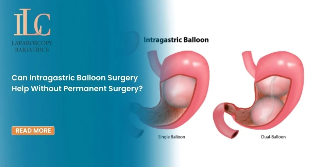 Can Intragastric Balloon Surgery Help Without Permanent Surgery