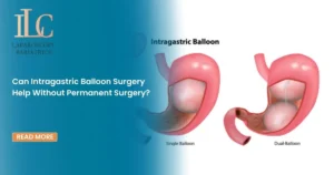 Can Intragastric Balloon Surgery Help Without Permanent Surgery