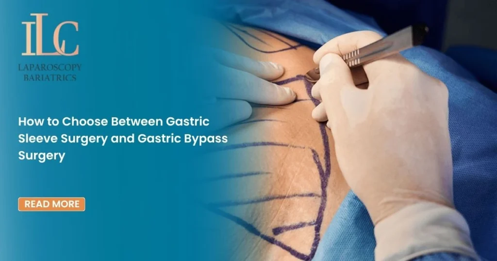 How to Choose Between Gastric Sleeve Surgery and Gastric Bypass Surgery
